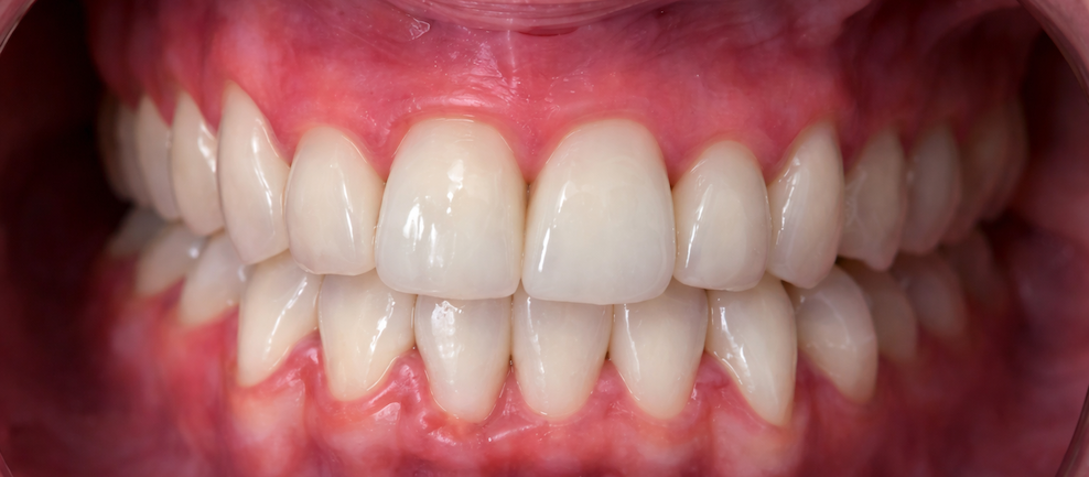 Before and after dental treatment at Revive Dentistry in Naperville IL