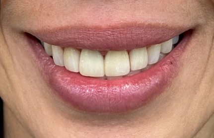Before and after dental treatment at Revive Dentistry in Naperville IL