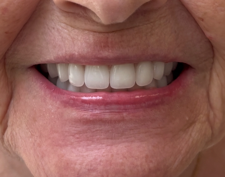 Before and after dental treatment at Revive Dentistry in Naperville IL