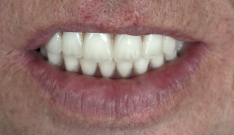 Before and after dental treatment at Revive Dentistry in Naperville IL