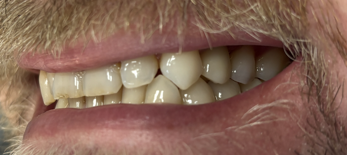 Before and after dental treatment at Revive Dentistry in Naperville IL