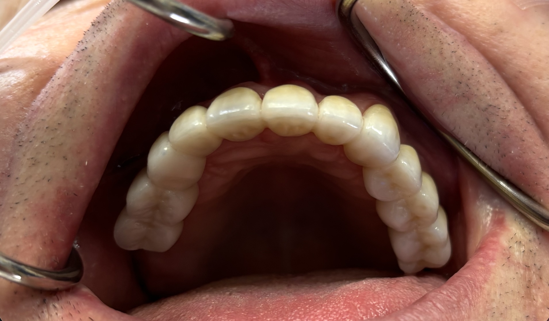 Before and after dental treatment at Revive Dentistry in Naperville IL