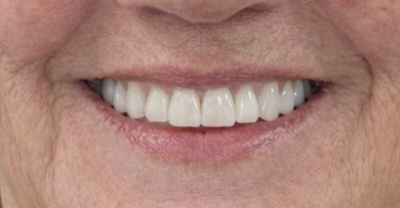 Before and after dental treatment at Revive Dentistry in Naperville IL