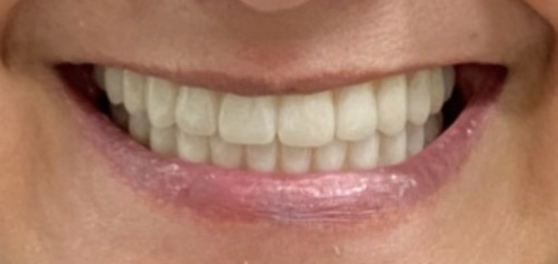 Before and after dental treatment at Revive Dentistry in Naperville IL