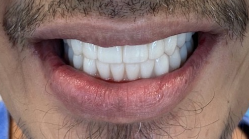 Before and after dental treatment at Revive Dentistry in Naperville IL