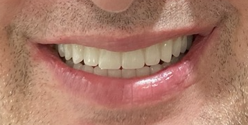 Before and after dental treatment at Revive Dentistry in Naperville IL