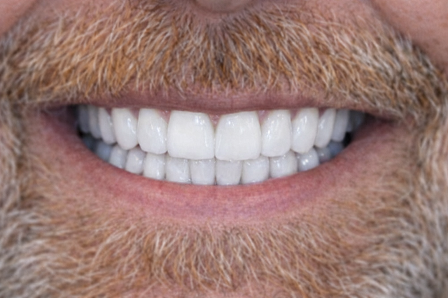 Before and after dental treatment at Revive Dentistry in Naperville IL