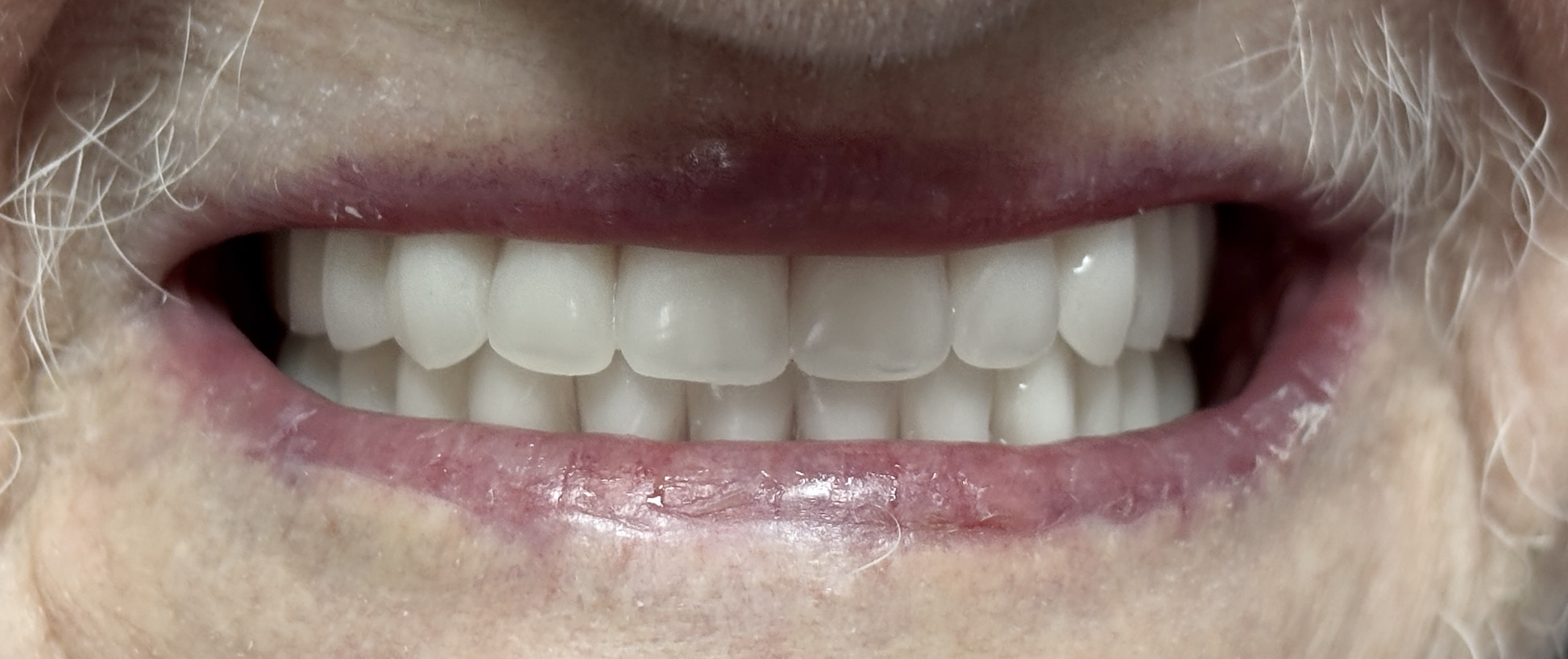 Before and after dental treatment at Revive Dentistry in Naperville IL