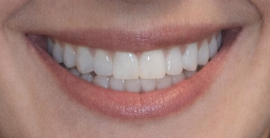 Before and after dental treatment at Revive Dentistry in Naperville IL
