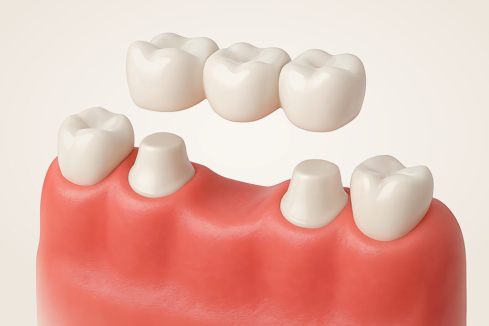 Fixed dental bridge replacing missing teeth at Revive Dentistry in Naperville IL