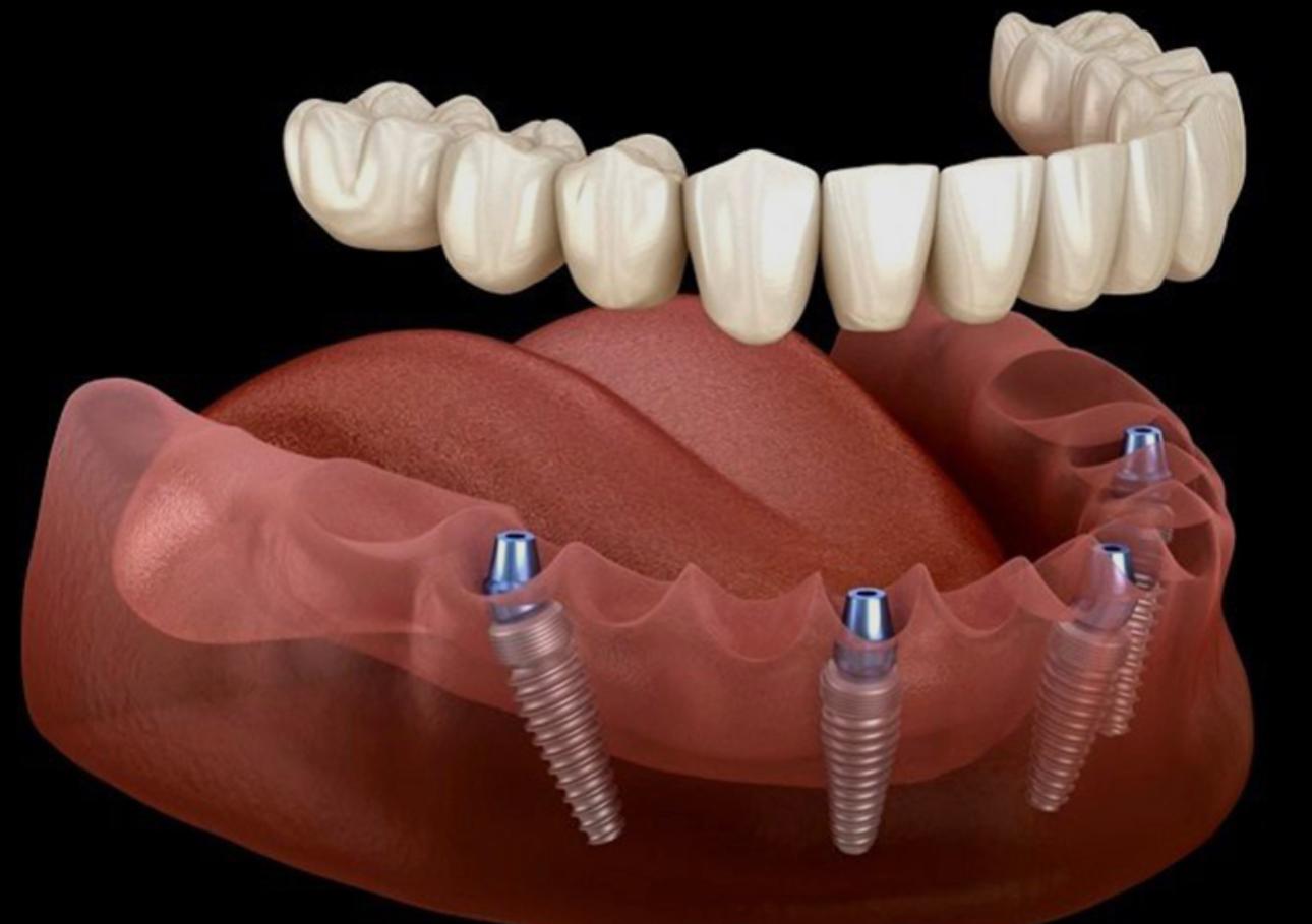 Dental implants and full-arch restoration at Revive Dentistry in Naperville IL
